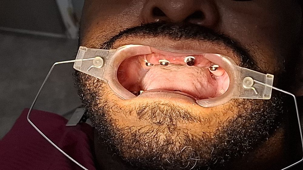 Caso 1 antes: arcada superior sin dientes