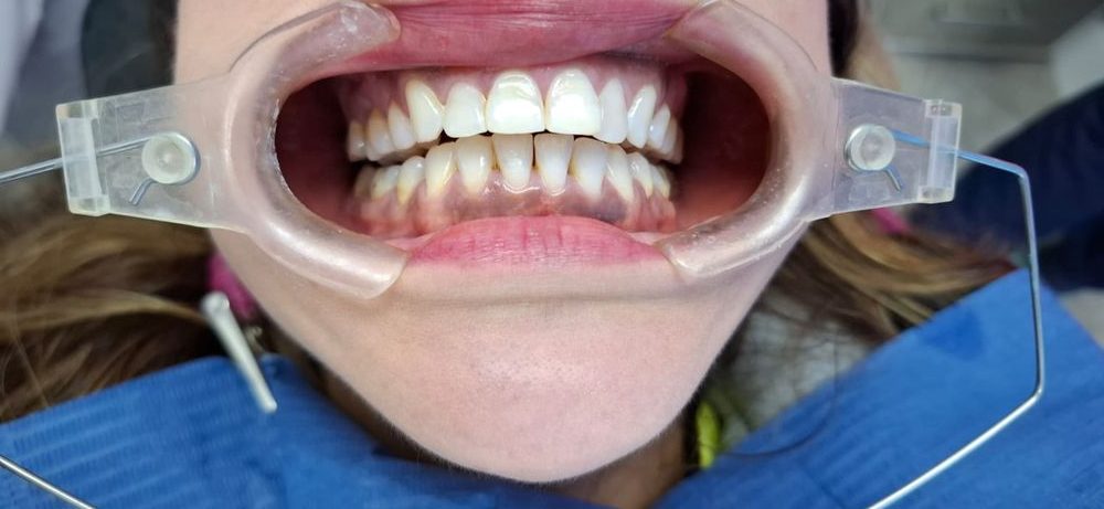 Caso 3 antes: dientes frontales