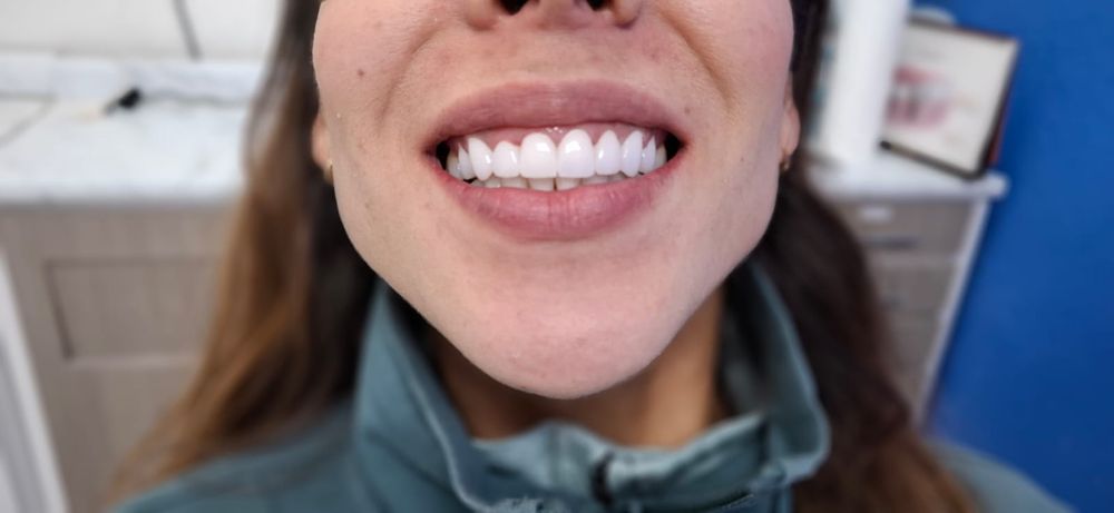Caso 3 después: dientes frontales restaurados