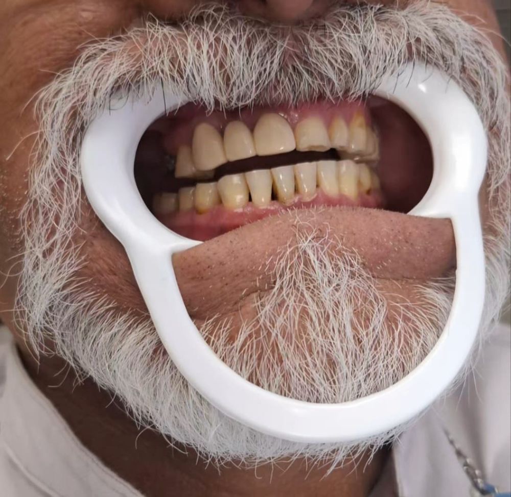 Caso 2 antes: dientes superiores desgastados