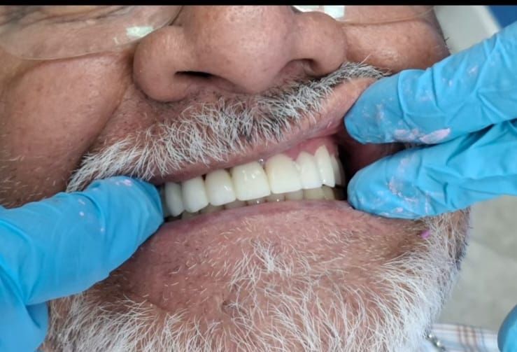Caso 2 después: dientes superiores rehabilitados